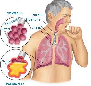 Polmonite batterica e polmonite atipica: in primavera polmonite virale e da mycoplasma