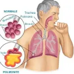 Polmonite batterica e polmonite atipica: in primavera polmonite virale e da mycoplasma