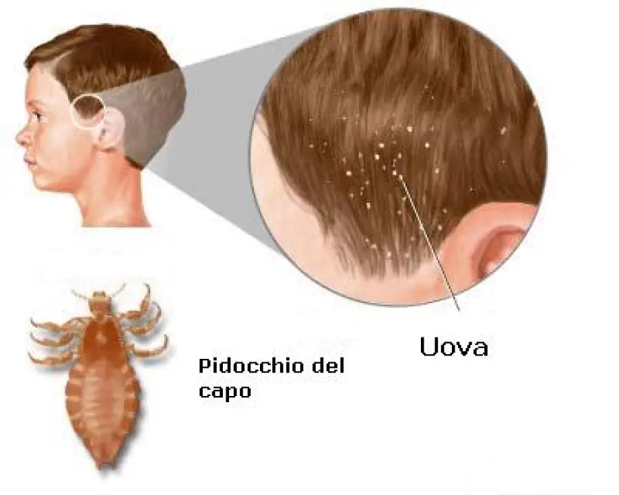Bambini e pidocchi dei capelli: gel e siliconi che soffocano i pidocchi