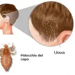 Bambini e pidocchi dei capelli: gel e siliconi che soffocano i pidocchi