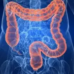 Cause rettocolite ulcerosa: malattia cronica intestinale. Sintomi, diagnosi e terapie di cura