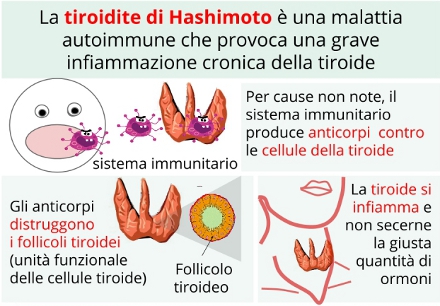 Tiroidite autoimmune: di Hashimoto (ipotiroidismo), morbo di Basedow (ipertiroidismo-occhi sporgenti)