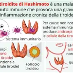 Tiroidite autoimmune: di Hashimoto (ipotiroidismo), morbo di Basedow (ipertiroidismo-occhi sporgenti)