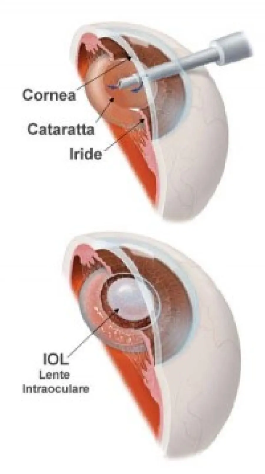 Intervento di cataratta dell' occhio: correggere anche astigmatismo, ipermetropia, difetti della vista