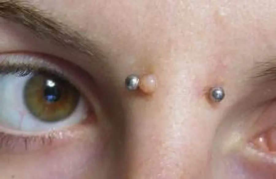 Cheloide cicatriziale dopo piercing e interventi chirurgici. Trattamenti per ridurre il cheloide