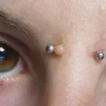 Cheloide cicatriziale dopo piercing e interventi chirurgici. Trattamenti per ridurre il cheloide