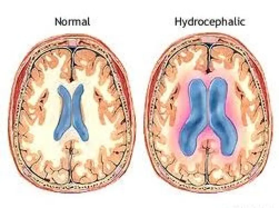 Demenza senile e idrocefalo normoteso: accumulo di liquido nel cervello. Cura: intervento chirurgico