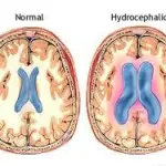 Demenza senile e idrocefalo normoteso: accumulo di liquido nel cervello. Cura: intervento chirurgico
