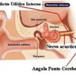 Neurinoma dell' acustico (tumore benigno). Sintomi associati: ipoacusia, ronzio o rumore all' orecchio