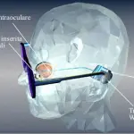 Impiantato un occhio bionico su un uomo quasi cieco. La sperimentazione a Pisa