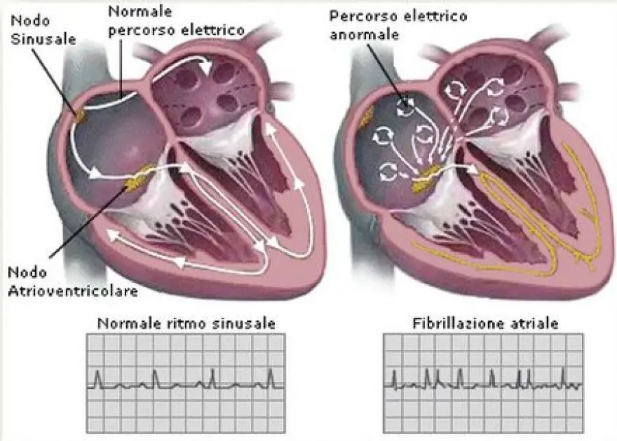 Cura aritmie cardiache: sintomi fibrillazione atriale e rischio ictus. Nuovi farmaci anticoagulanti orali