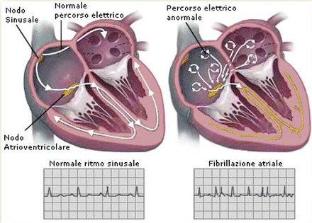 Cura aritmie cardiache: sintomi fibrillazione atriale e rischio ictus. Nuovi farmaci anticoagulanti orali