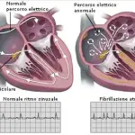 Cura aritmie cardiache: sintomi fibrillazione atriale e rischio ictus. Nuovi farmaci anticoagulanti orali