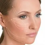 Lifting viso con fili riassorbibili: ringiovanire il viso senza riduzione della mimica facciale
