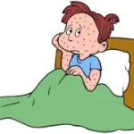 Varicella: cosa fare contro il prurito. Per i bambini vaccino contro la varicella