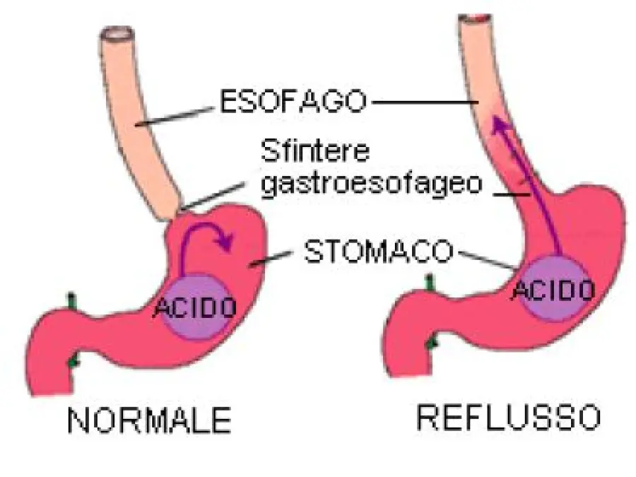 Problemi digestivi: mal di stomaco, bruciore, acidità, reflusso gastroesofageo aumentano d' estate
