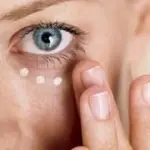 Eliminare occhiaie con filler di grasso corporeo prelevato dal paziente: cellule staminali concentrate