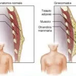 Riduzione seno uomo: ginecomastia vera (squilibrio ormonale) e ginecomastia falsa (sovrappeso)